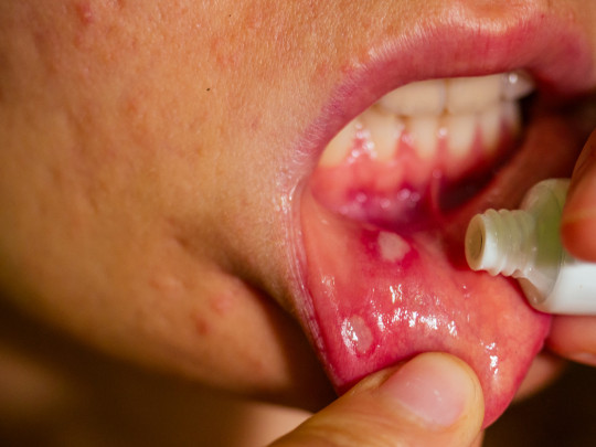 Persona con lesiones en la boca por VPH