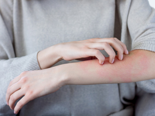 Mujer con comezón en le brazo por infección en la piel