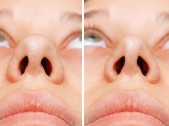 Joven muestra el antes y después del masaje para reducir la nariz ancha sin cirugía.
