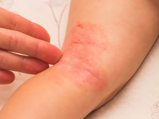IInfección de sarna en la piel o de hongos
