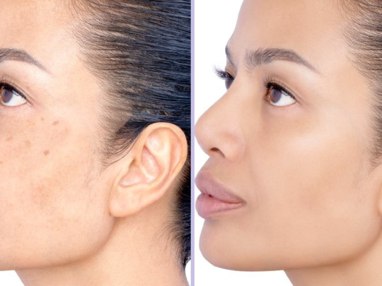 Mujer manchas en la piel antes y después