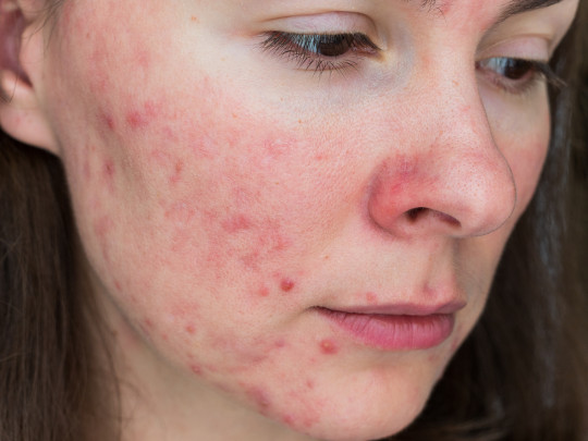Mujer con problemas de acné en la piel 