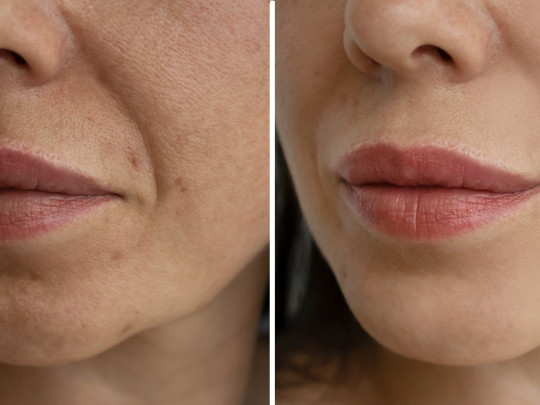 Mujer con arrugas en los labios comparación antes y después