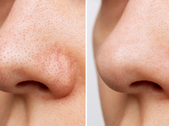 Mujer con poros abiertos de la nariz antes y después
