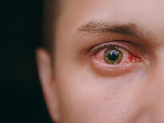 Hombre con ojos rojos por sífilis ocular