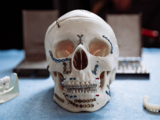 Maqueta de cráneo con modificaciones para hablar sobre la cirugía maxilofacial: Qué es y para qué se hace