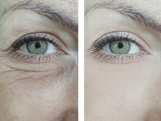Mujer con arrugas en el rostro antes y después