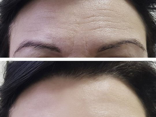Mujer con arrugas en la frente antes y después