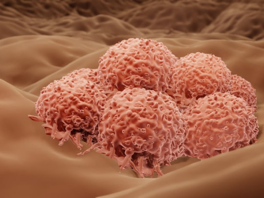 Células cancerígenas de melanoma