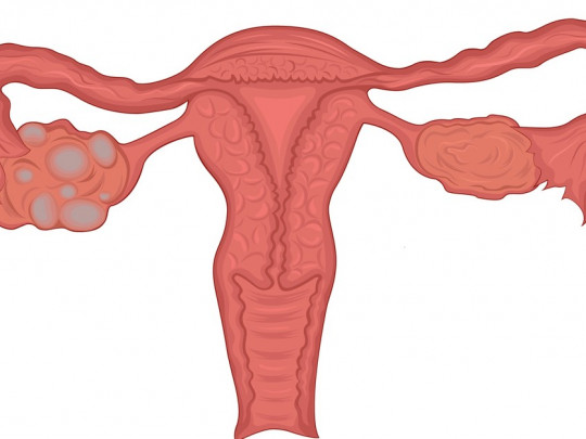 ¿Puedo quedar embarazada si tengo síndrome del ovario poliquístico?