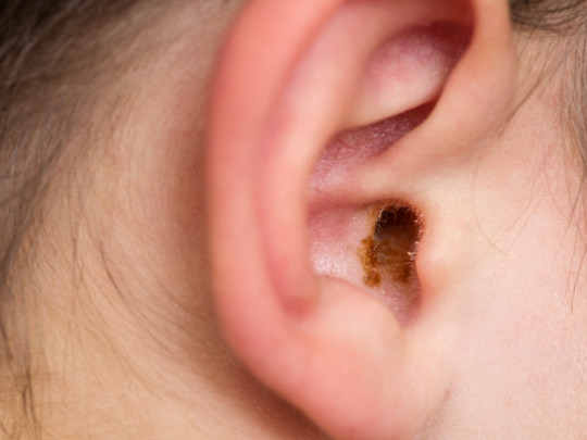 ¿Prestar tus audífonos podría provocarte fuerte infección en los oídos ...