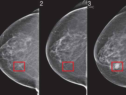 Mamografía de mujer con cáncer de mama