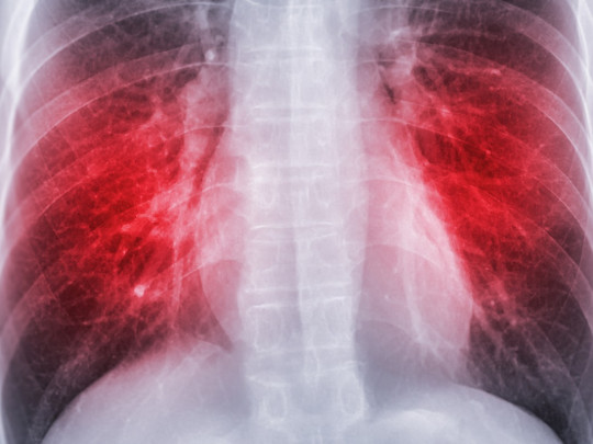 Mujer sufre embolia pulmonar en plena cirugía.