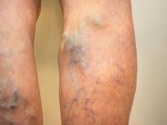 Mujer con piernas varicosas