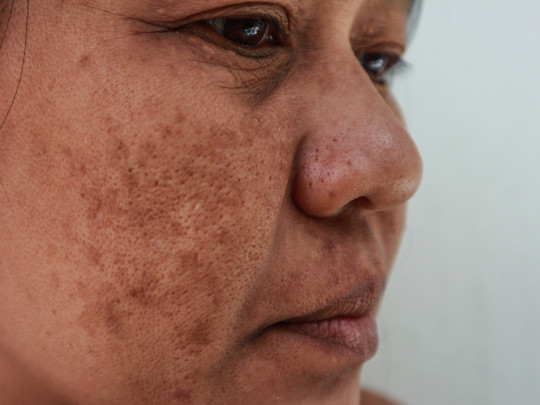 Mujer con manchas de melasma en el rostro