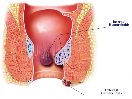 Hemorroide interna ilustración