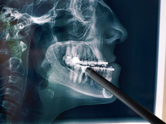 Radiografía de la cabeza para hablar sobre la cirugía maxilofacial: Qué es y para qué se hace