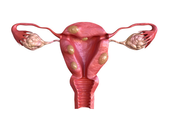Miomas uterinos