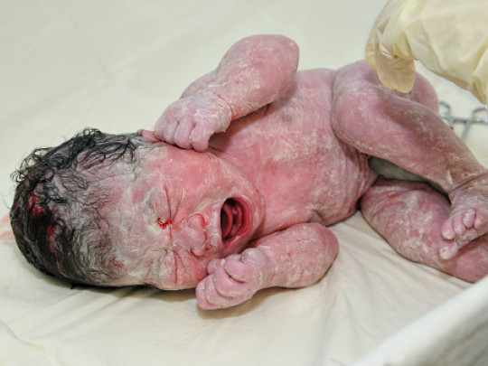 Bebé recien nacido con vérnix caseos