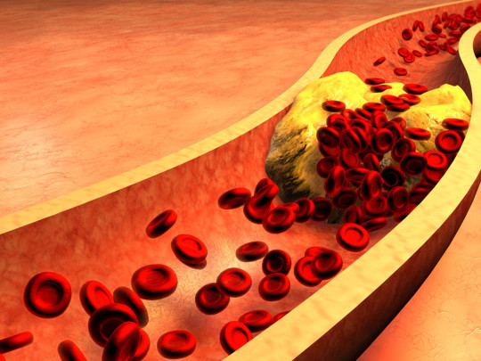 Ilustración de arterias bloqueadas por colesterol