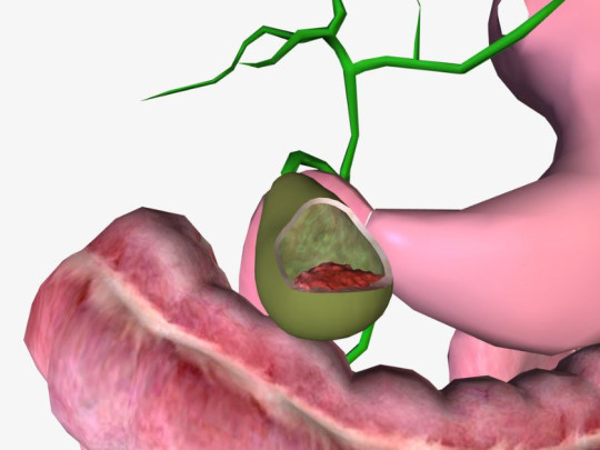 ilustración de cáncer de páncreas