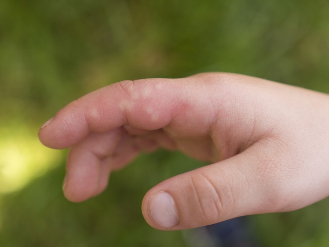 Por qué se hinchan los dedos de las manos | Salud180