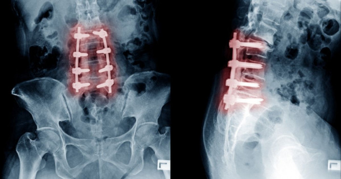 Lesión en la columna al nivel de cuello.