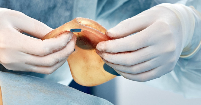Implante mamario.