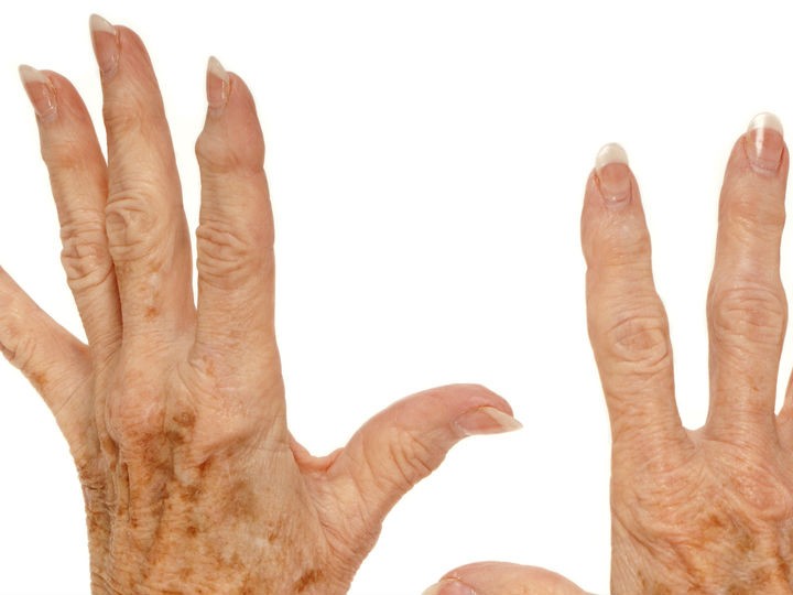 Incomparable Presentar globo Cómo eliminar las manchas y arrugas de las manos