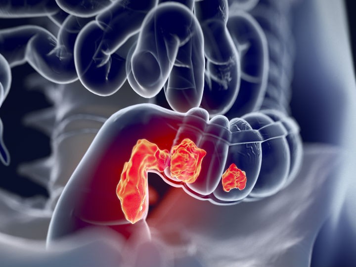 Cancer de colon y sus sintomas
