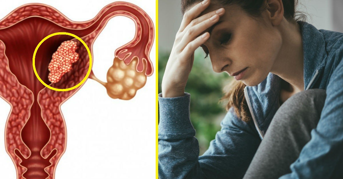 4 Síntomas de pólipos uterinos que puedes detectar muy a tiempo
