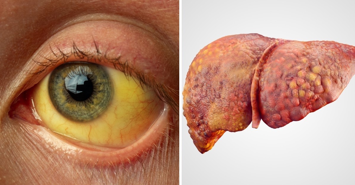Cáncer de hígado: síntomas de este mal silencioso y cómo la cirrosis  aumenta tu riesgo