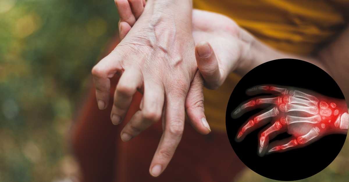 Ahorro interferencia Extraer Por qué se deforman las manos: artritis reumatoide y artrosis, dos grandes  causas