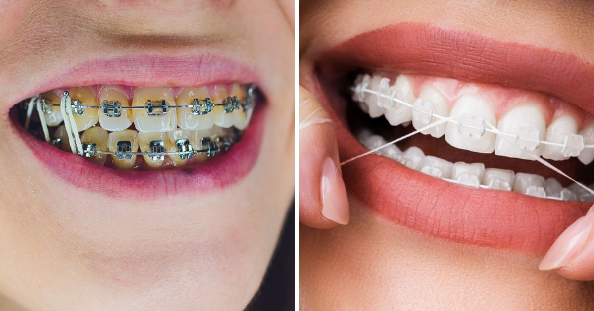 Diferentes tipos de brackets con el hilo dental. 