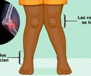 Piernas en X (genu valgum): la deformidad que podría torcer las rodillas de tu hijo