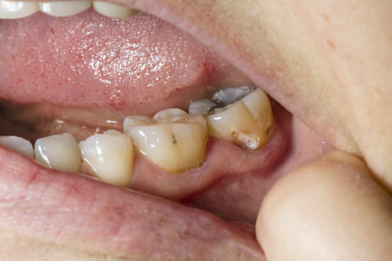 Otra manera en que afectan a tu cuerpo es por medio de los dientes, el ácido cítrico u ortofosfórico que contienen desgasta el esmalte de los dientes 