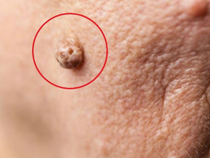 Las verrugas son crecimientos del tejido en la piel que son causados por un virus, pero que no son dañinas, siempre y cuando haya otros síntomas que acompañen su aparición.
