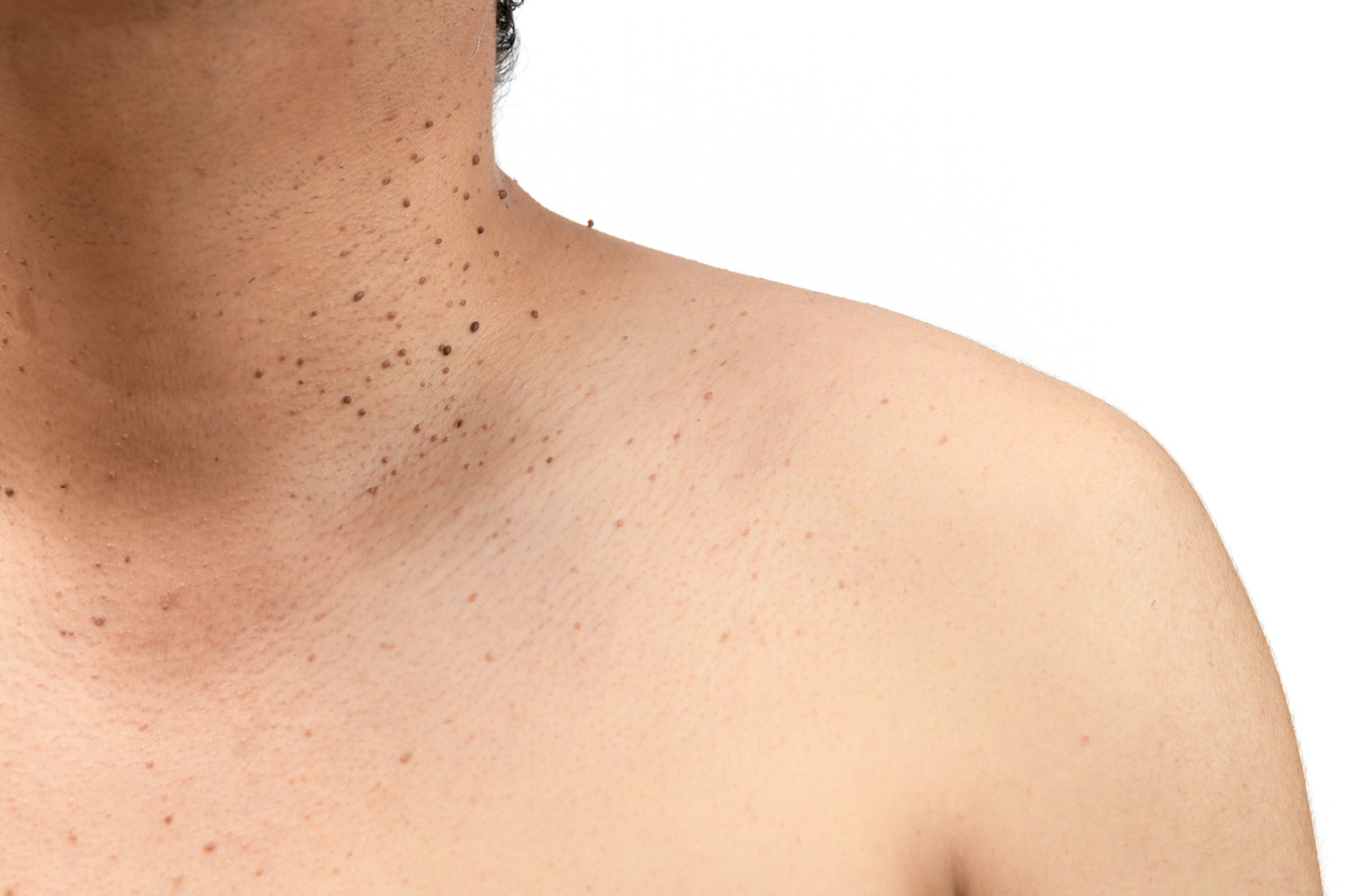 Las verrugas comunes normalmente aparecen en zonas como el cuello, las ingles o la cara.