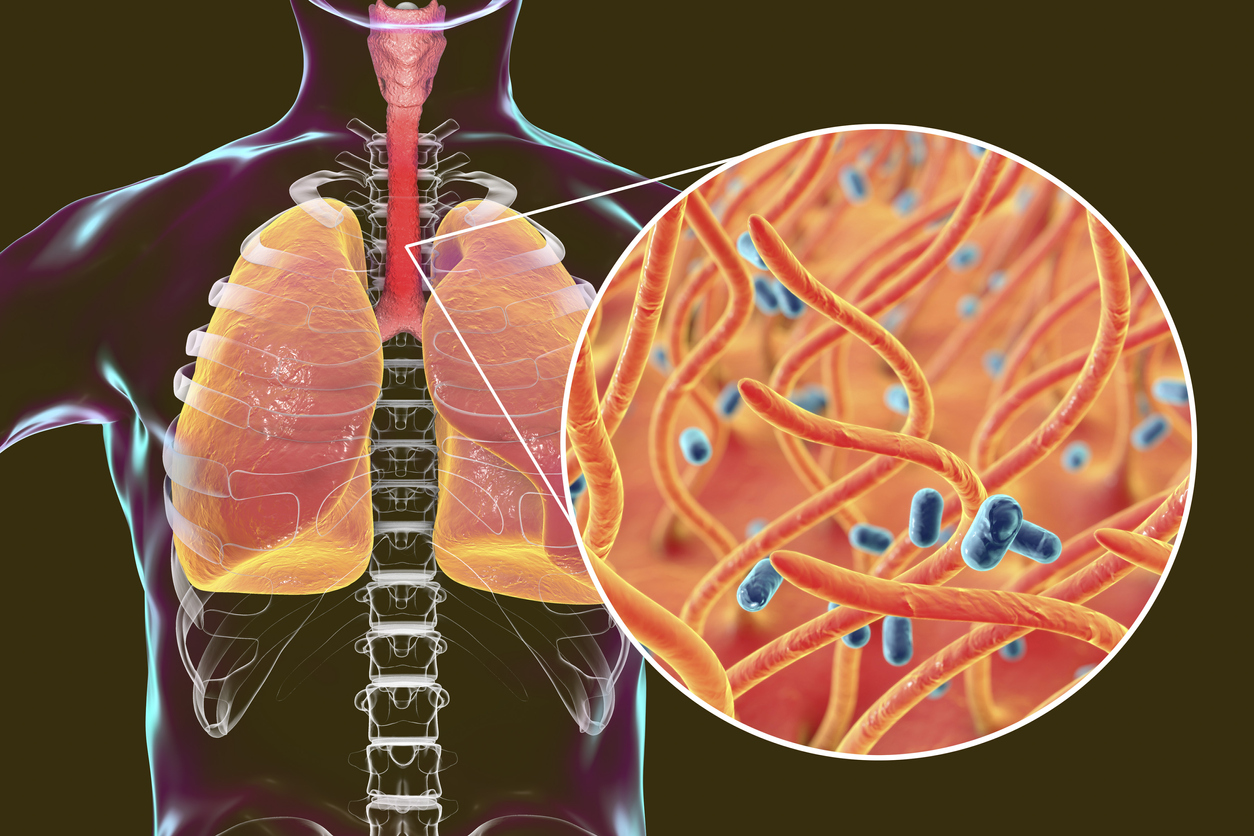 Tener antecedentes de enfermedades como el EPOC, pueden ser una de las principales causas de que se desarrolle el cáncer en los pulmones.